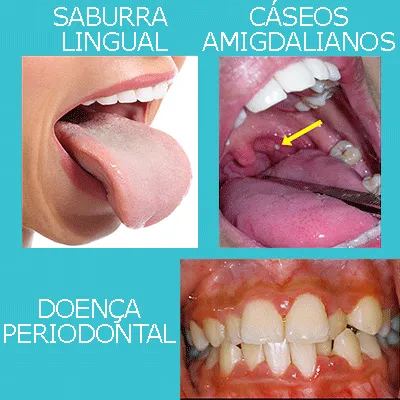 As 3 Principais Causas do Mau Hálito