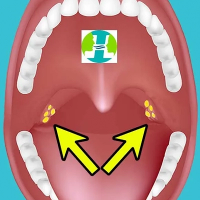 Cáseos: Conheça as bolinhas fedidas que aparecem na garganta