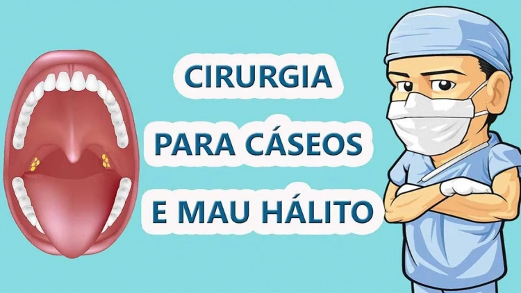 Massinhas fedidas na garganta (Caseo Amigdaliano): Como se livrar